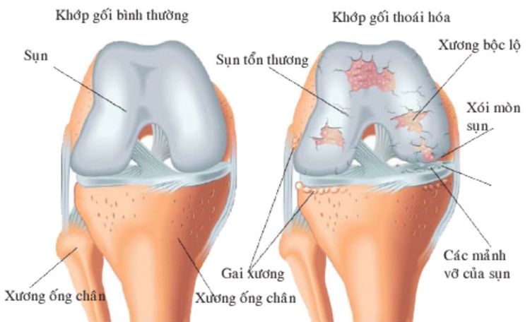 Tổn thương thoái hóa khớp
