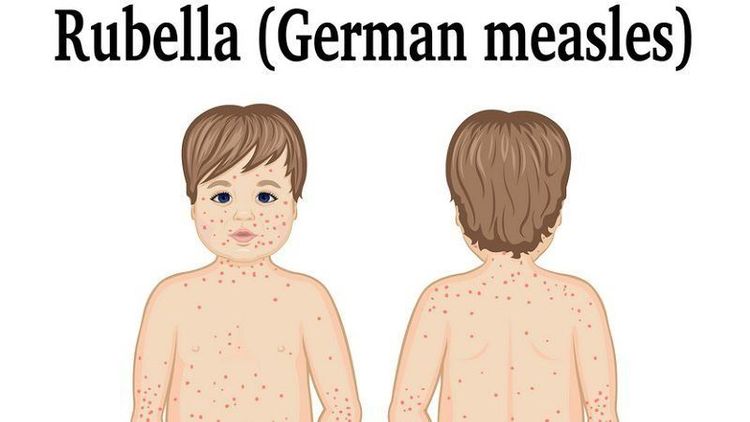 
Bệnh rubella với triệu chứng phát ban trên da
