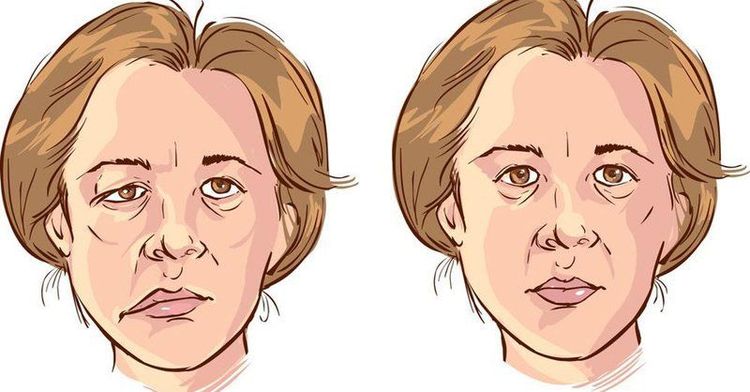 
Chronic otitis media with perforated eardrum can cause facial nerve paralysis
