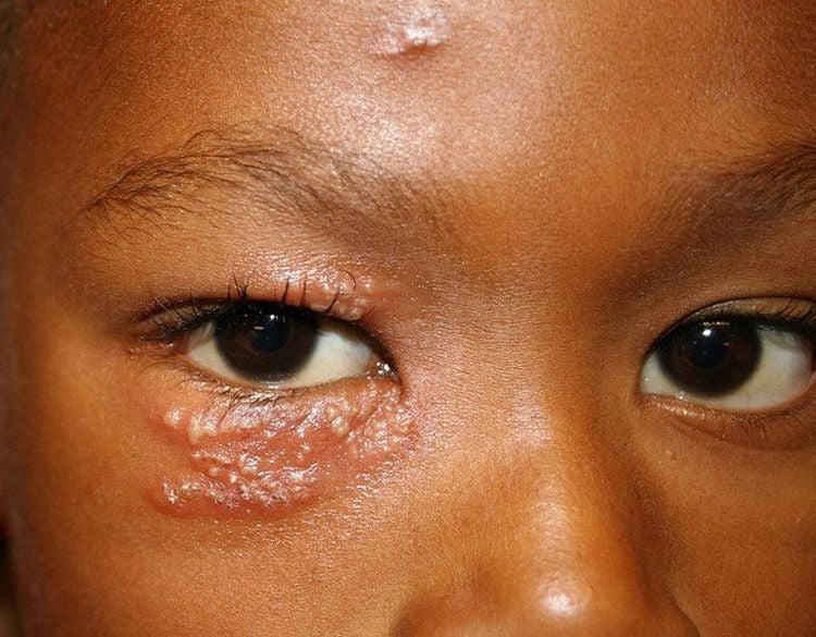 
Bệnh zona ở mắt là do virus varicella-zoster gây ra
