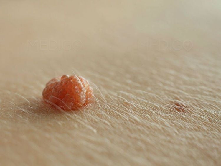 
HPV ở nam giới gây ra mụn cóc ở dương vật
