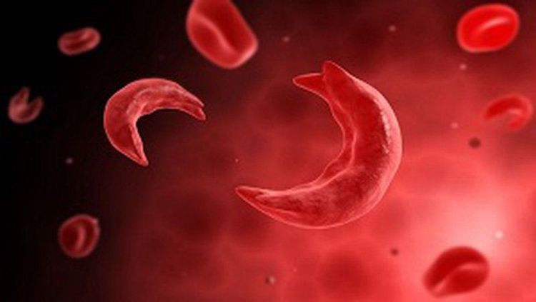 Sickle cell anemia can lead to chronic red blood cell deficiency.