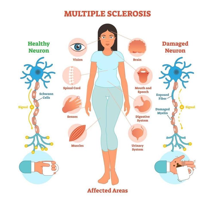 What is multiple sclerosis?