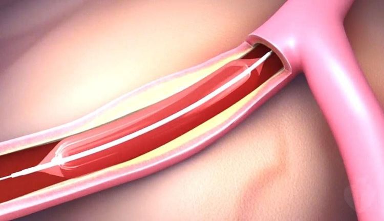 
Stent mạch vành giúp dòng máu được tái lưu thông
