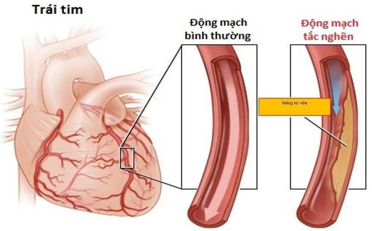 
Nhồi máu cơ tim do mảng xơ vữa
