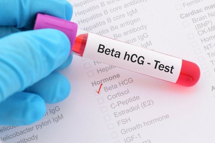 Xét nghiệm máu beta hCG giúp chẩn đoán sảy thai sớm