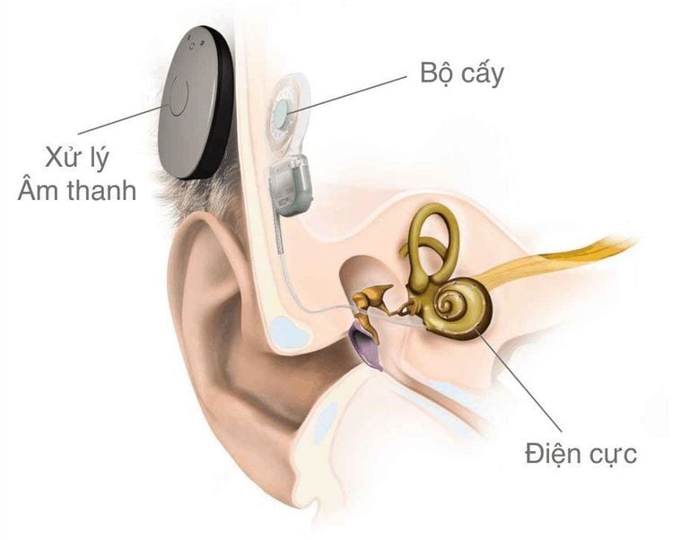 
Người có thiết bị điện tử như cấy ghép ốc tại không thể thực hiện chụp MRI
