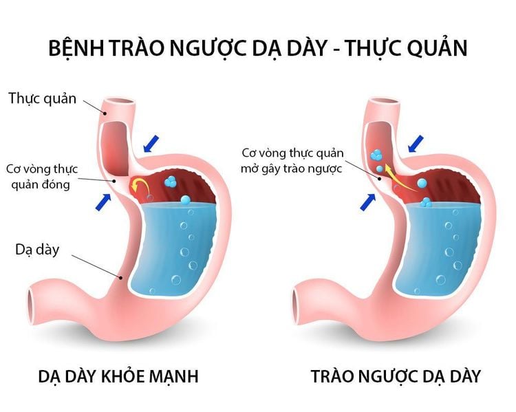 Gastroesophageal reflux in premature infants