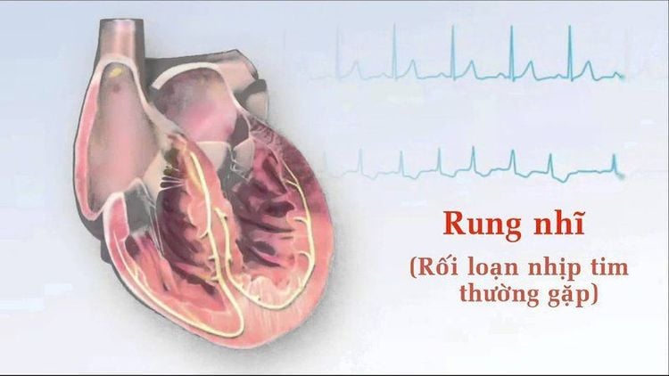 
Nhiều bệnh nhân rung nhĩ không có bất kỳ yếu tố nguy cơ nào
