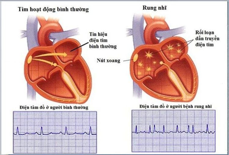 
Bệnh rung nhĩ còn làm tăng nguy cơ mắc đột quỵ lên đến 5 lần so với những người bình thường
