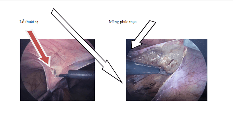 
Phúc mạc – màng bụng mỏng xung quanh lỗ thoát vị được bóc ra
