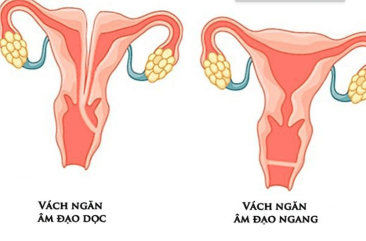 
Vách ngăn âm đạo dọc và ngang
