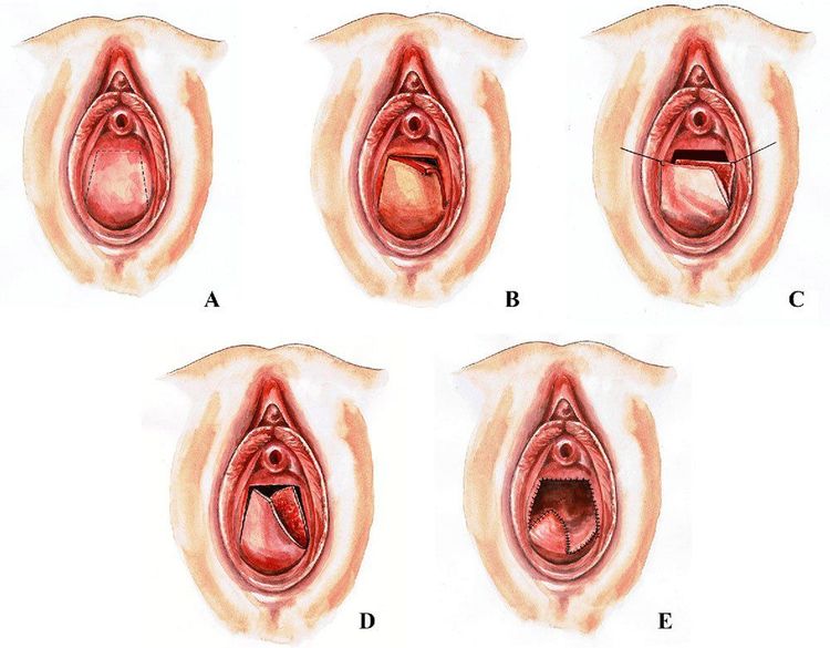 
Một số bước cơ bản trong quy trình cắt vách ngăn âm đạo ngang
