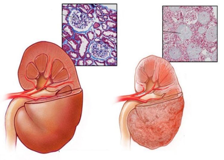 
Bệnh lý suy thận có thể gây tăng chỉ số BUN
