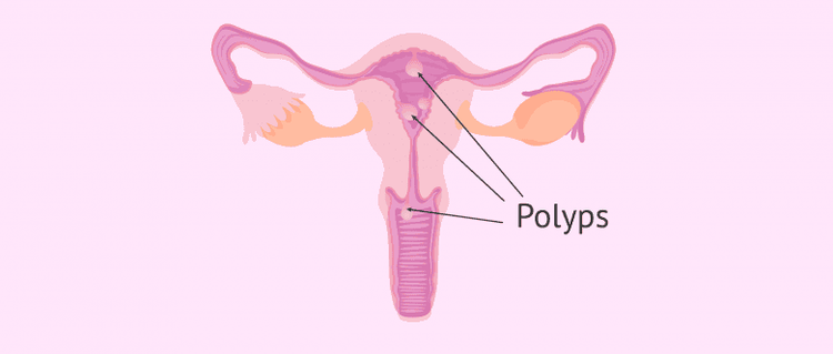 
Hình ảnh polyp buồng tử cung
