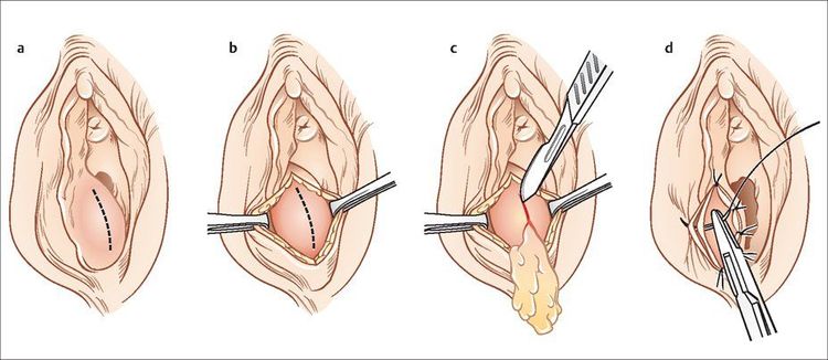 
Bóc nang tuyến Bartholin
