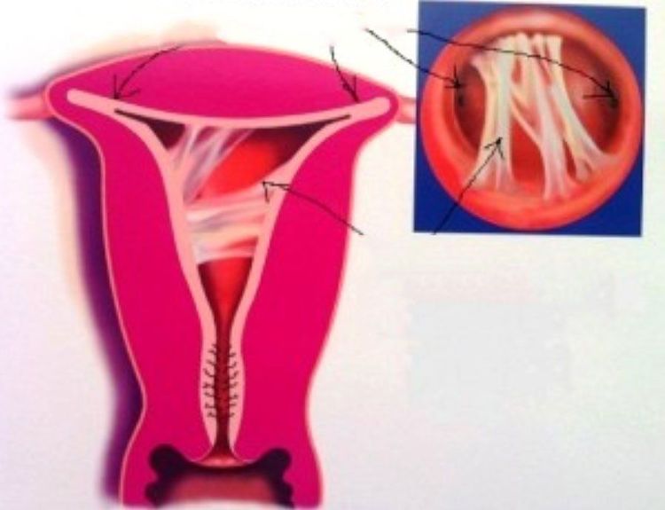 
Dính niêm mạc buồng tử cung
