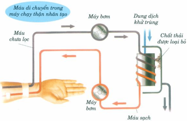 
Chạy thận giúp bệnh nhận suy thận kéo dài tuổi thọ
