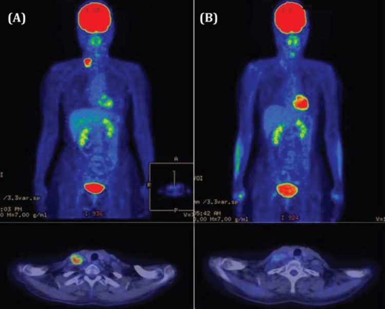 
Kết quả chụp chụp PET/CT giúp chuẩn đoán chính xác
