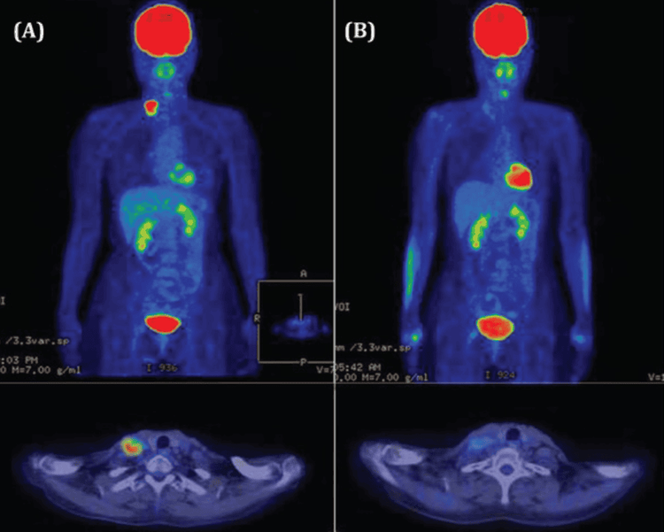 
Kết quả hình ảnh chụp PET/CT
