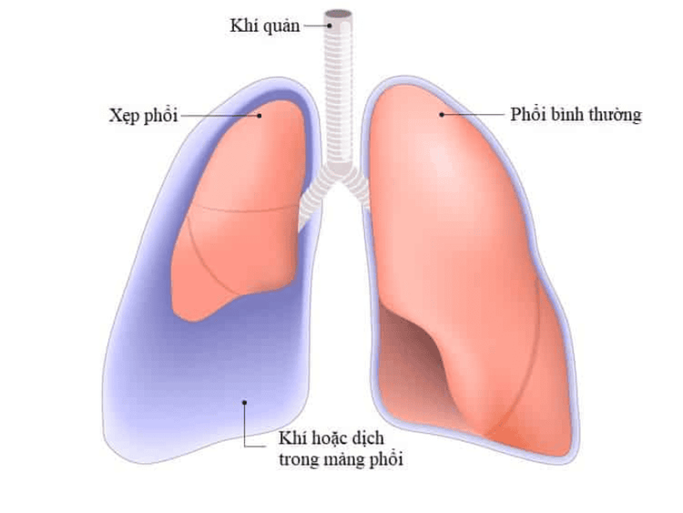 
Xẹp phổi có thể xảy ra khi thực hiện lọc rửa phổi
