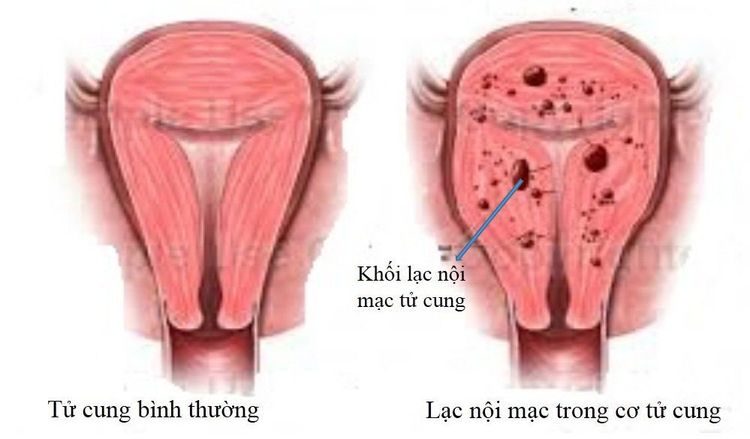 
Lạc nội mạc tử cung
