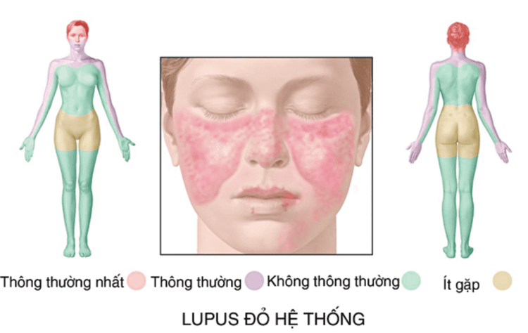 
Bệnh Lupus ban đỏ hệ thống có thể là nguyên nhân gây viêm màng ngoài tim
