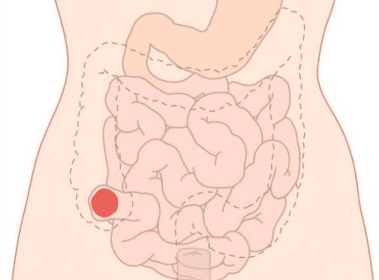 
Mở hậu môn nhân tạo là một trong những cuộc phẫu thuật lớn
