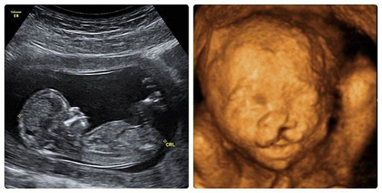 
Cleft palate can be detected through ultrasound
