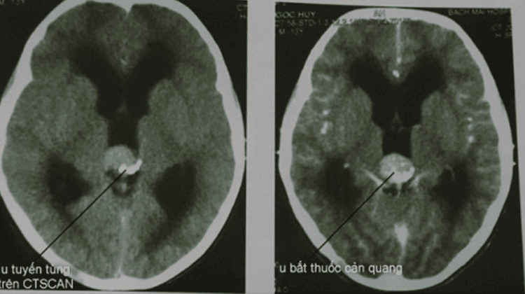 
Kết quả CT-Scan u tuyến tùng
