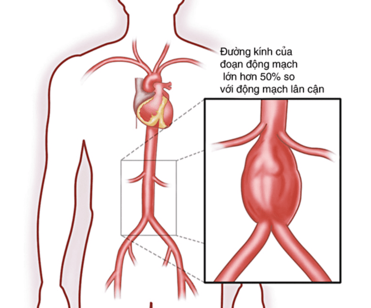 
Phình động mạch chủ là hiện tượng động mạch chủ bị phình to ra hơn so với bình thường,
