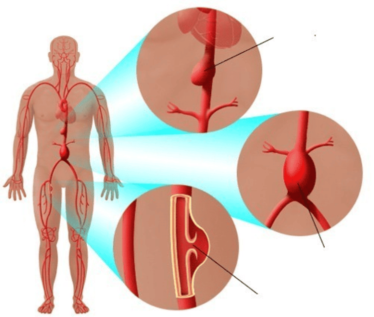 
Nguyên nhân hiếm gặp làm phình động mạch chủ là do nhiễm trùng không được điều trị
