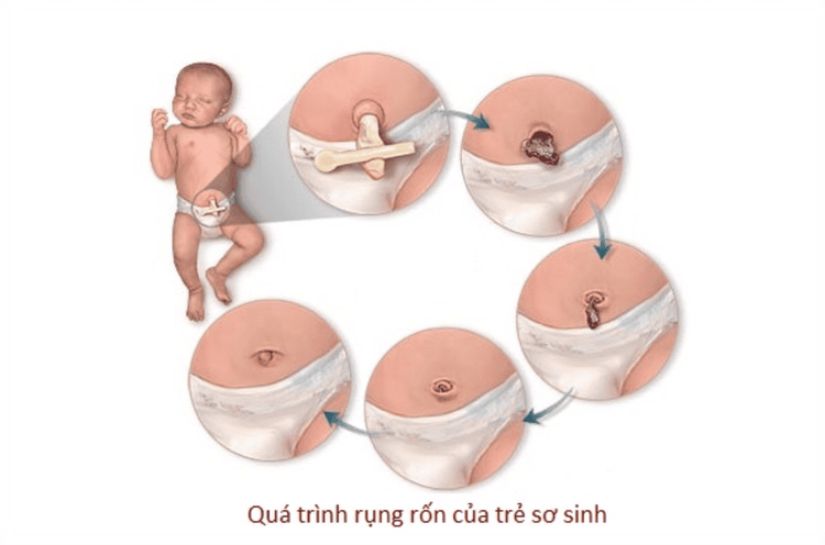 Nhiễm trùng rốn trẻ sơ sinh