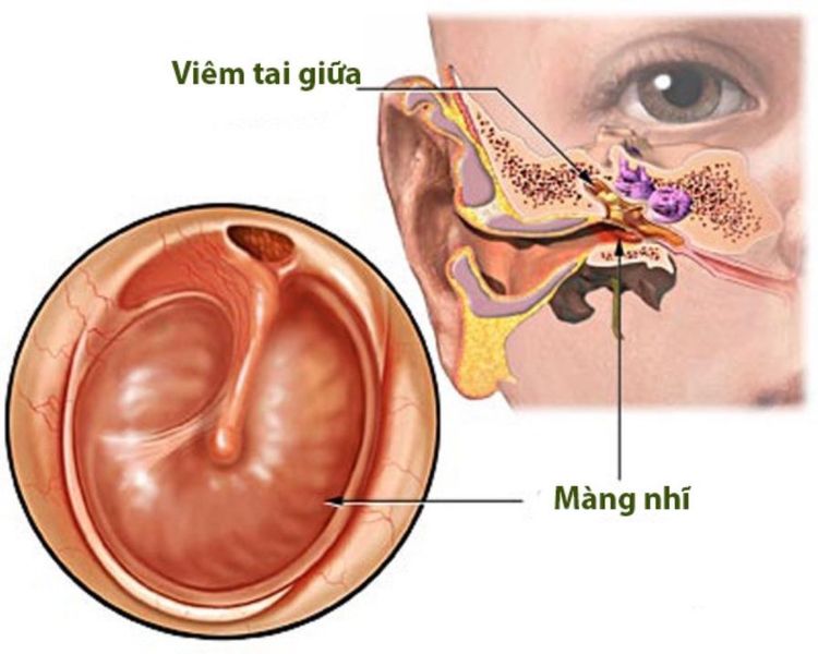 
Xẹp nhĩ có thể xảy ra ở toàn bộ màng nhĩ hoặc chỉ xảy ra ở một phần của màng chùng
