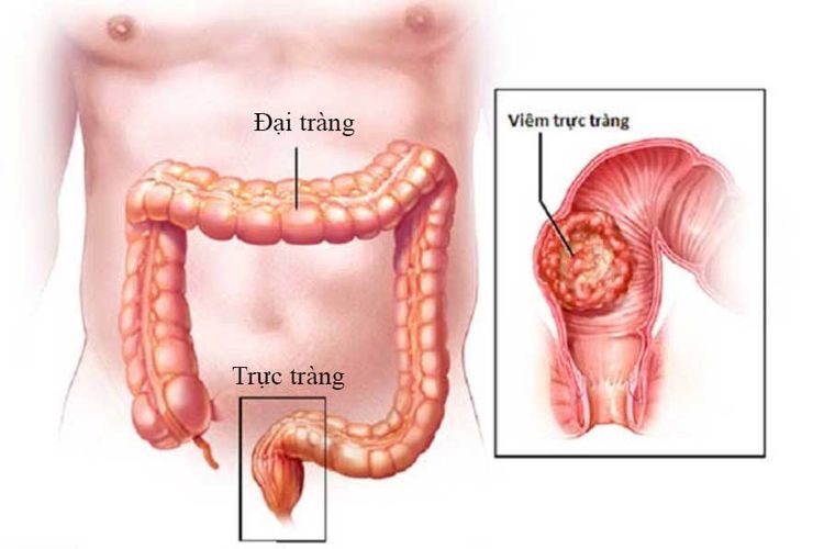 
Tình trạng viêm trực tràng
