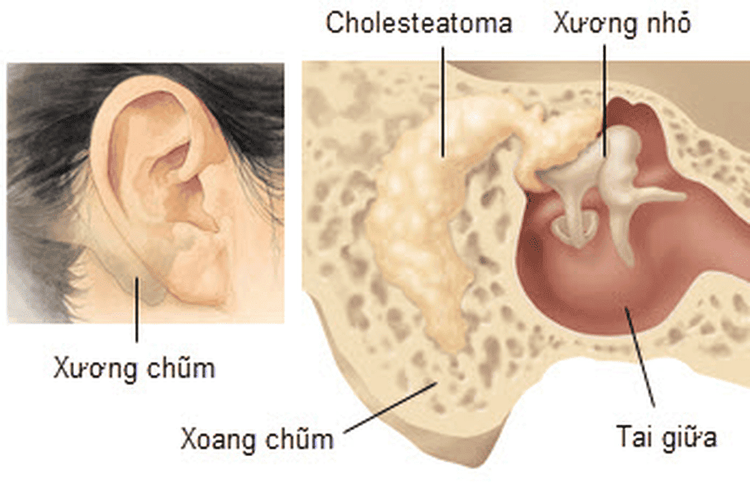 
Viêm xương tai chũm
