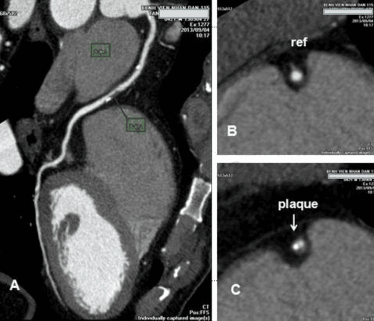 
Ảnh chụp MSCT mạch vành của một bệnh nhân nam, 42 tuổi, đau ngực không điển hình, chụp CT mạch vành: A/Hình Curved MPR của động mạch vành phải cho thấy có 2 mảng xơ vữa vôi hóa ở đoạn 2 trong đó mảng xơ vữa thứ 2 (mũi tên xanh) gây hẹp lòng động mạch vành 50-70%. B/ Hình cắt ngang lòng động mạch vành đoạn tham khảo (ref) ngay trên chỗ hẹp. C/ Hình cắt ngang lòng động mạch vành phải đoạn 2 qua mảng xơ vữa thứ 2.
