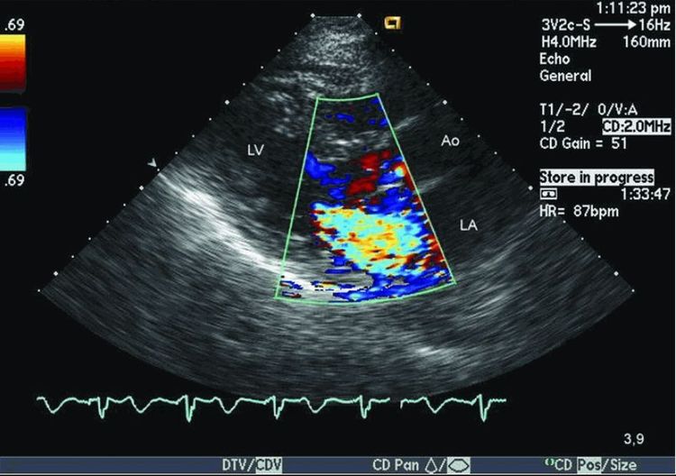 
Kết quả siêu âm tim doppler phát hiện bệnh lý van tim
