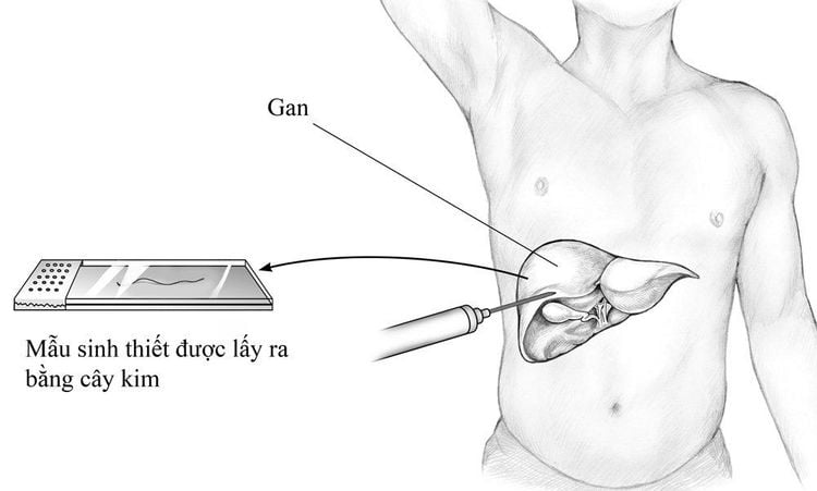 
Quá trình lấy mẫu sinh thiết gan
