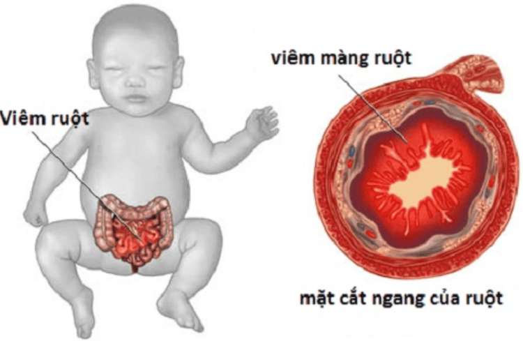 
Hoại tử ruột trẻ sơ sinh khó xác định nguyên nhân
