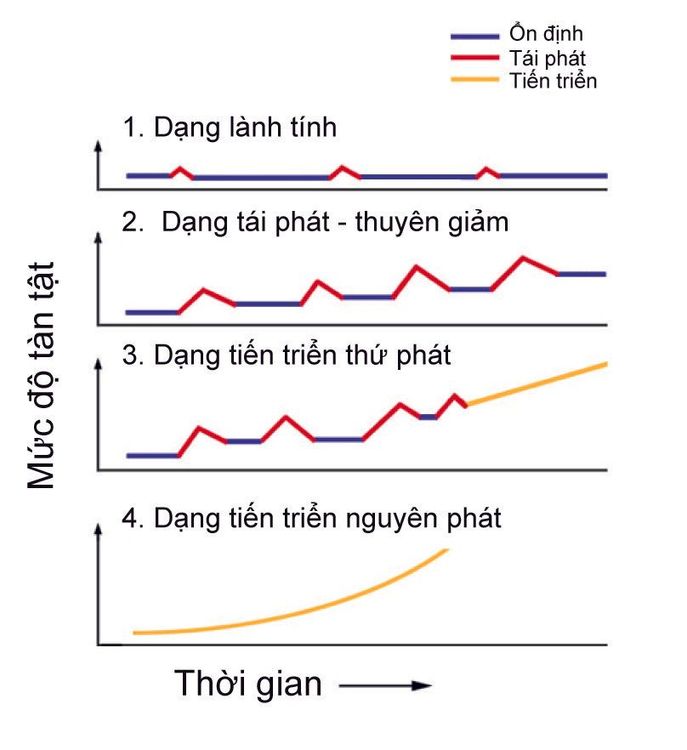 
Các giai đoạn tiến triển của bệnh xơ cứng rải rác
