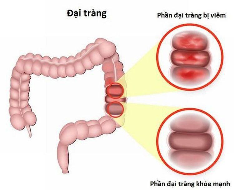 
Viêm đại tràng có thể là nguyên nhân thứ phát gây bệnh tan máu tự miễn
