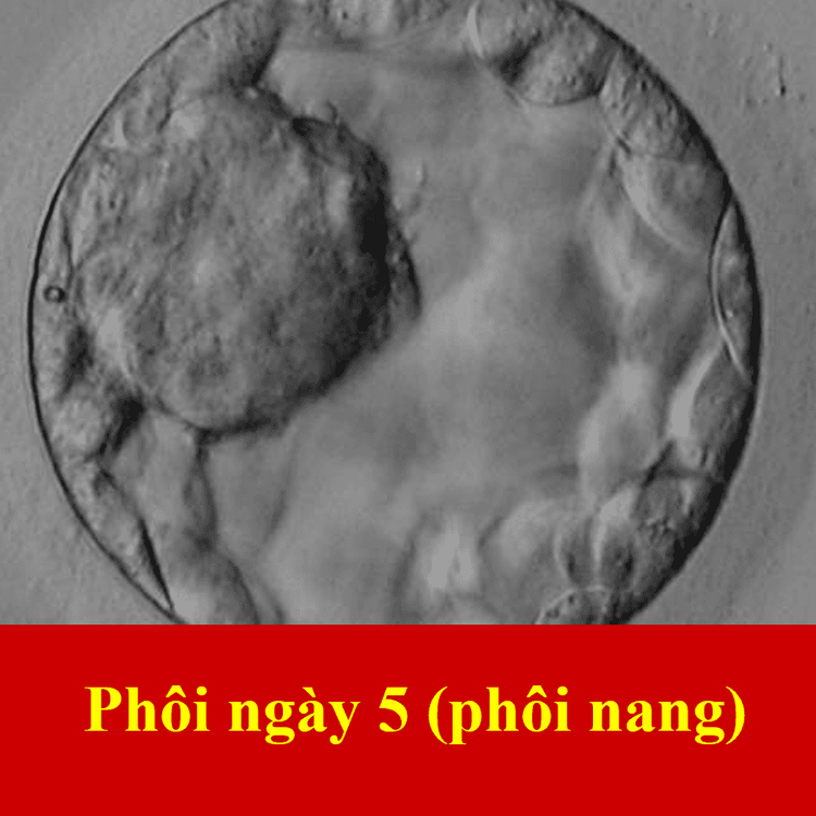 
Giai đoạn phôi nang (Ngày 5+)
