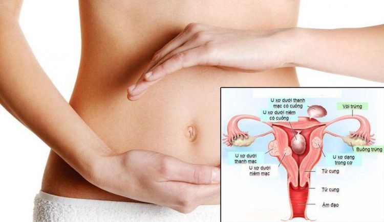 U xơ tử cung là những khối u cơ có thể phát triển trên tử cung phụ nữ