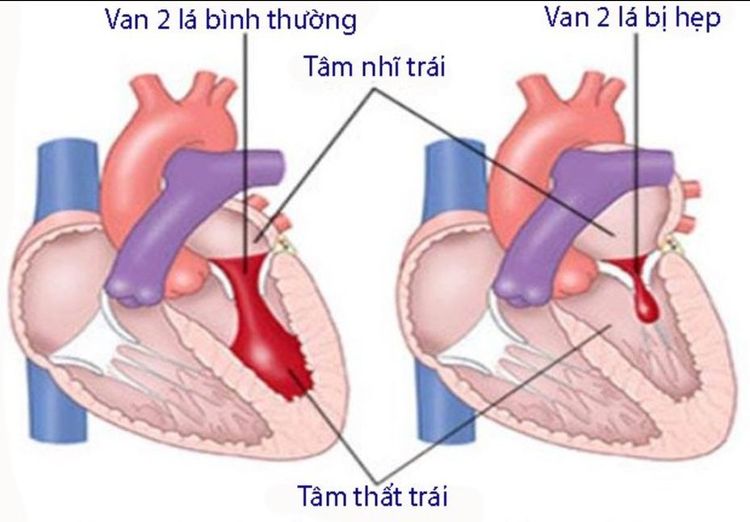 
Siêu âm tim giúp đánh giá hiệu quả tình trạng bệnh van 2 lá
