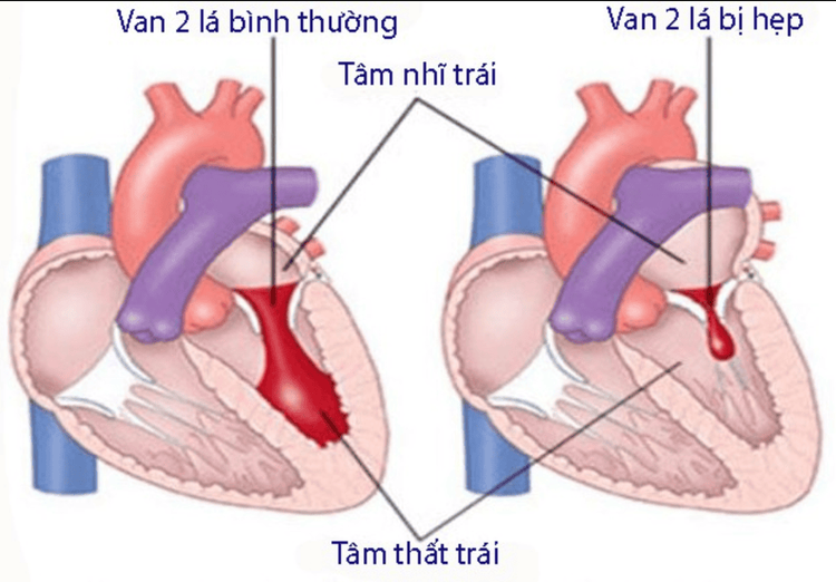 
Hình ảnh van 2 lá bị hẹp
