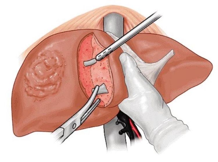 
Hình ảnh mô phỏng cắt gan
