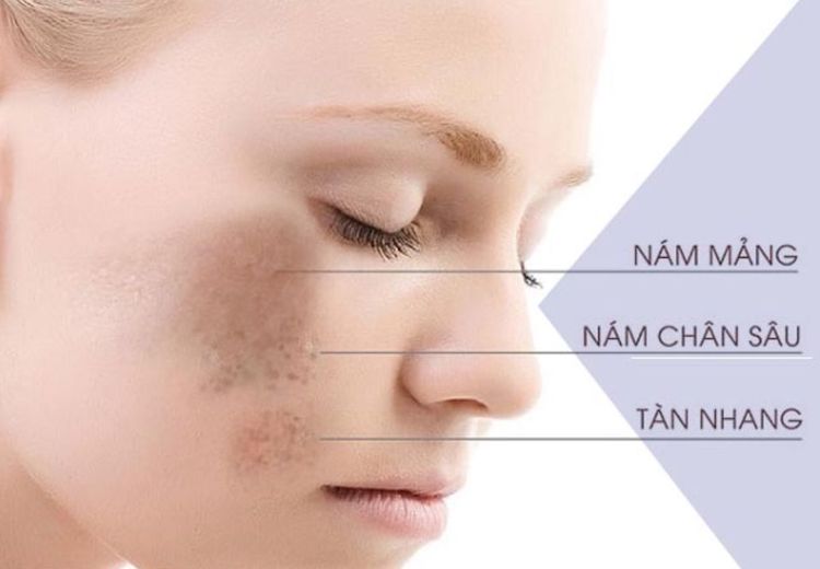 
Hình ảnh nám chân sâu (nám nội tiết)
