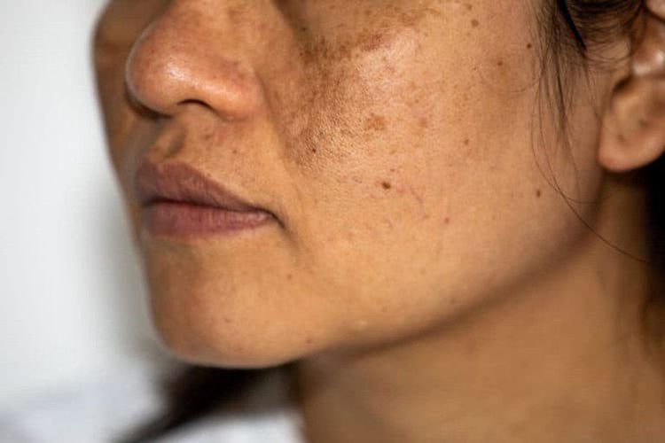 
Location of appearance of endocrine melasma
