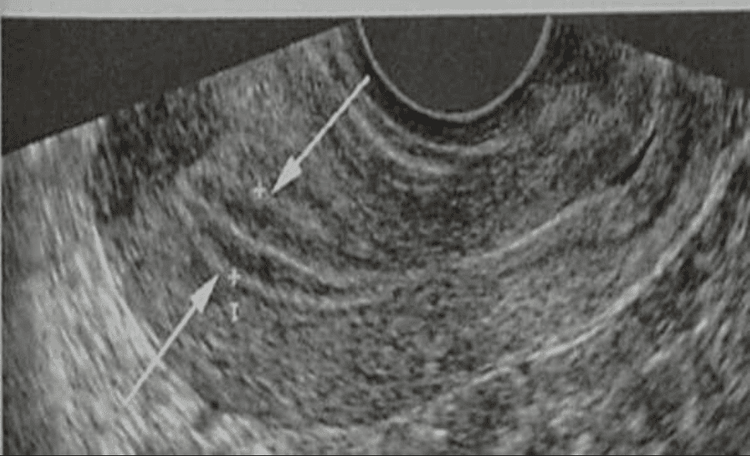 
Ultrasound image of the uterine lining
